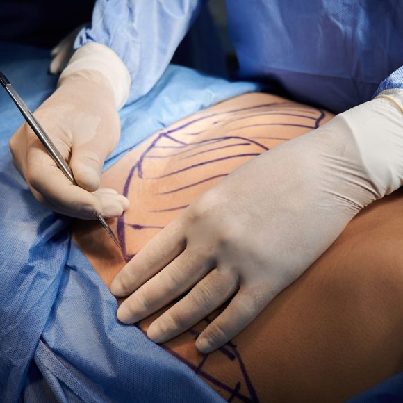 plastic surgery colombia - cirugia plastica colombia